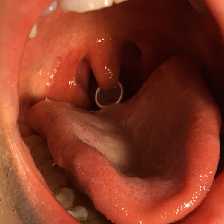 Uvula piercing with a ring