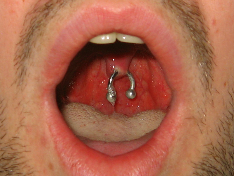Uvula piercing with a solid ring
