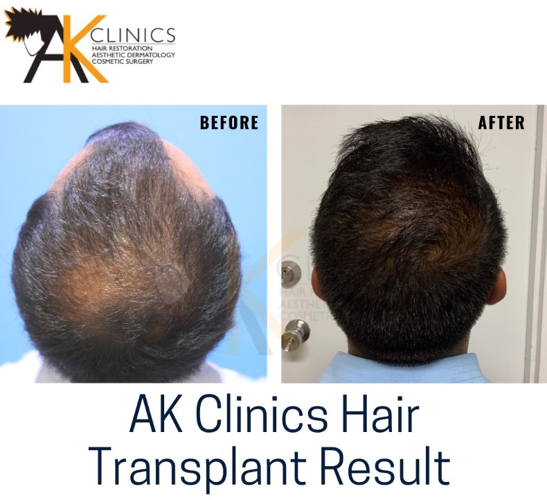 Before-After Hair Transplant Image by AK Clinic, Patiala