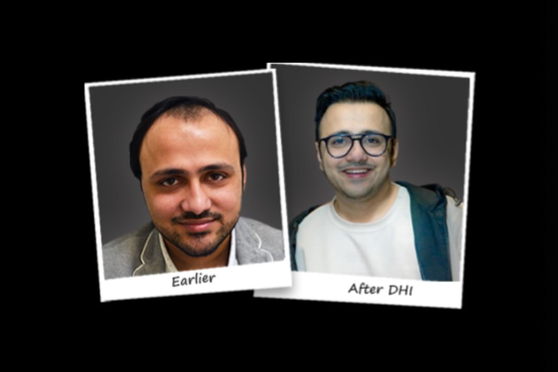 Before-After Hair Transplant Image by DHI