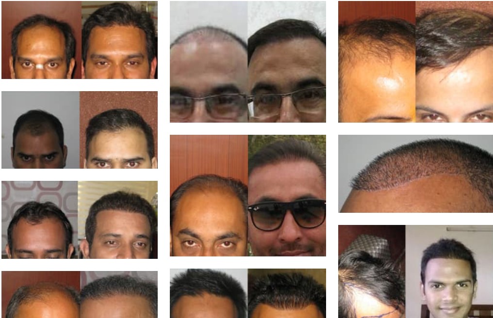 Before-After Hair Transplant Image by Dr Kalia, Chandigarh