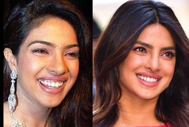 Priyanka Chopra Before and After Tooth Implants