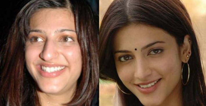 Shruthi Hassan Before and After Tooth Implants