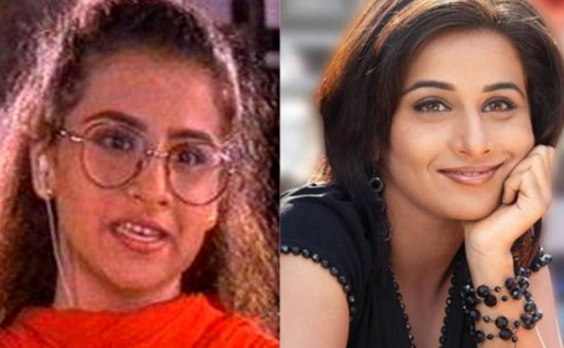 Vidya Balan Before and After Tooth Implants